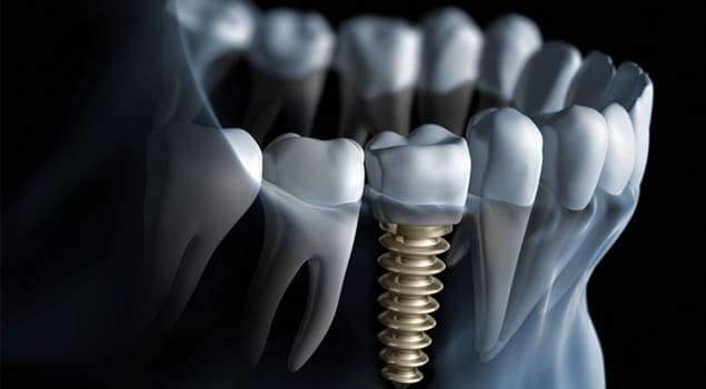 Advanced Dental Implants Jamshedpur