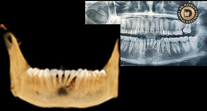 Crowns and Bridges treatment jamshedpur